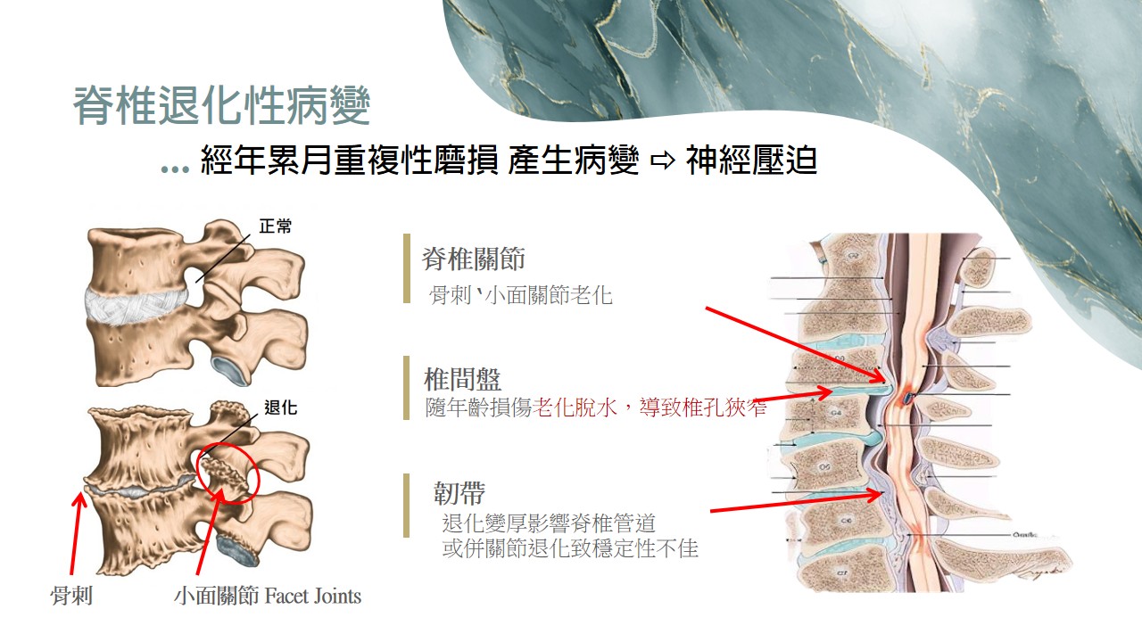 頸椎退化性病變示意圖